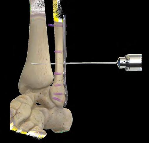 3 JuggerLoc Bone-to-Bone System Surgical Technique Figure 2a Figure 3a Figure 2 Figure 3 Drill Fibula and Tibia Under fluoroscopy, insert