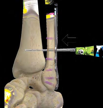 anteriorly until purchase past the 1st tibial cortex has been achieved (Figure 4, 4a) (A mallet should be