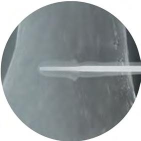 The inserter shaft has a step-down (or decrease in thickness) where the implant ends (Figure 5a).