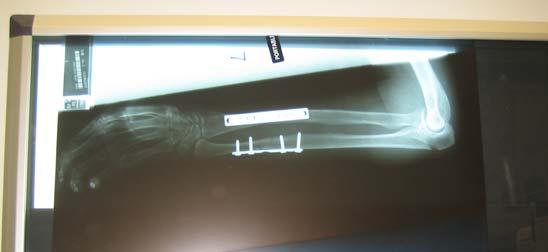 Treatment of Forearm Fractures Aims: 1. Restoration of length and their anatomical relation - normal forearm axis 2.