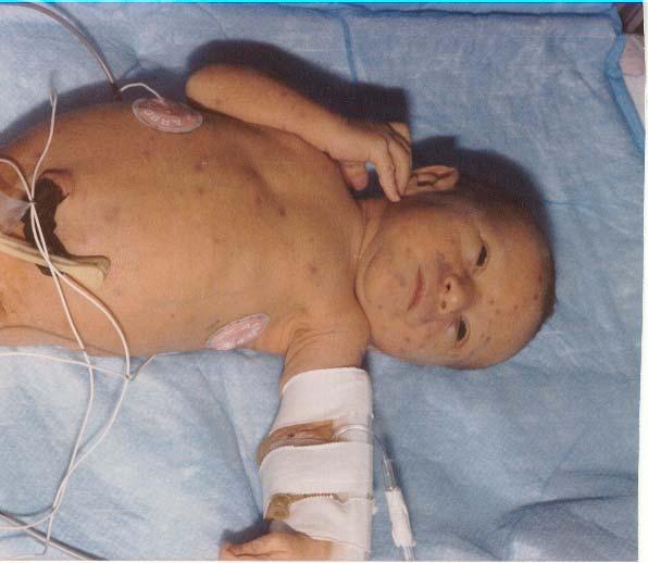 Newborn with Symptomatic