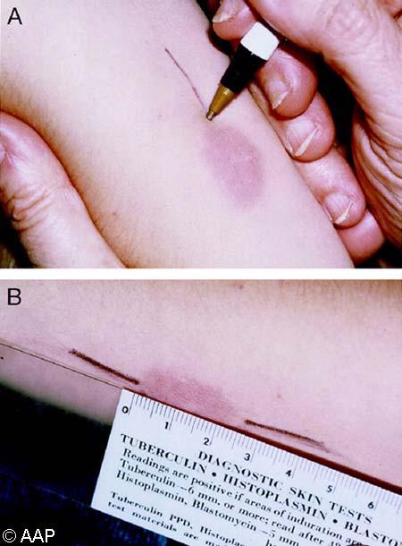 Reading the TB Skin Test Measure induration, not erythema!