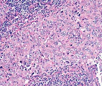 Gloyeske et al / Low ER+ Breast Cancer A B C D Image 1 Examples of low estrogen receptor positive invasive ductal carcinoma demonstrating high-grade nuclei (A, 200), intratumoral lymphocytic