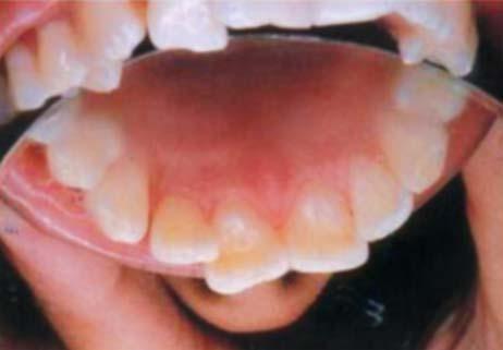 3: Clinical examination: Palatal view He complained of mobility, discomfort and poor esthetics with 12.