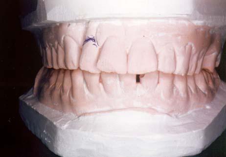 The periodontal prognosis of the tooth was very poor and the tooth was advised for extraction.