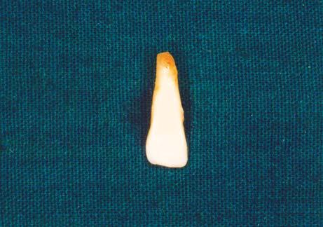 WJD Natural Tooth Pontic using Fiber-reinforced Composite for Immediate Tooth Replacement MI, USA) was applied to the etched enamel but not cured.