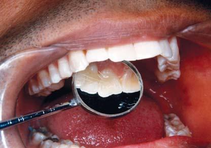 9A: Post-treatment photograph The key advantages of this technique are excellent esthetics, preservation of tooth structure and