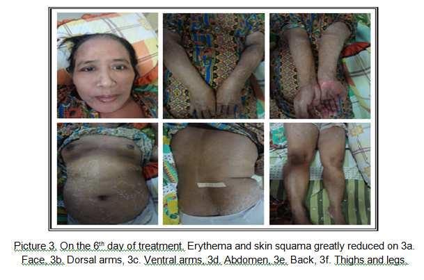 Asrawati Sofyan Erythroderma Caused Drug Allergies Patients diagnosed with erythroderma due to drug eruption, erythroderma d ue to psoriasis vulgaris.