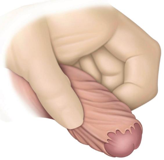 Sometimes, though, the foreskin is too tight. It can close over the glans and become unable to move (Fig. 1). This condition is called phimosis.