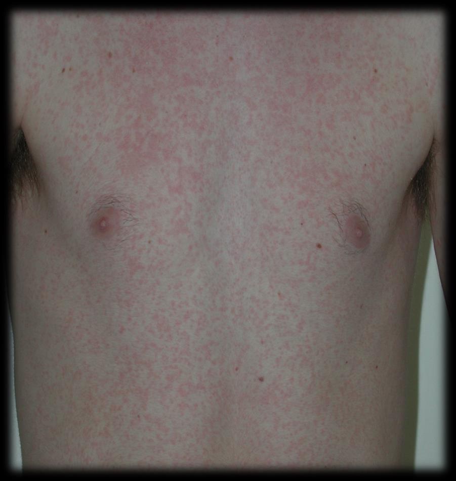 rash after treatment