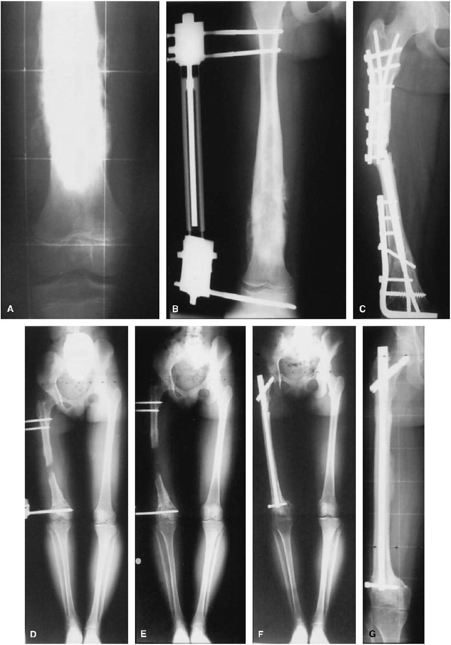 Figure 1. An 8-year-old girl diagnosed with osteosarcoma in the distal femur in 1989 (A). She was treated by epiphysiolysis, resection of the tumor, and intercalary reconstruction (B).