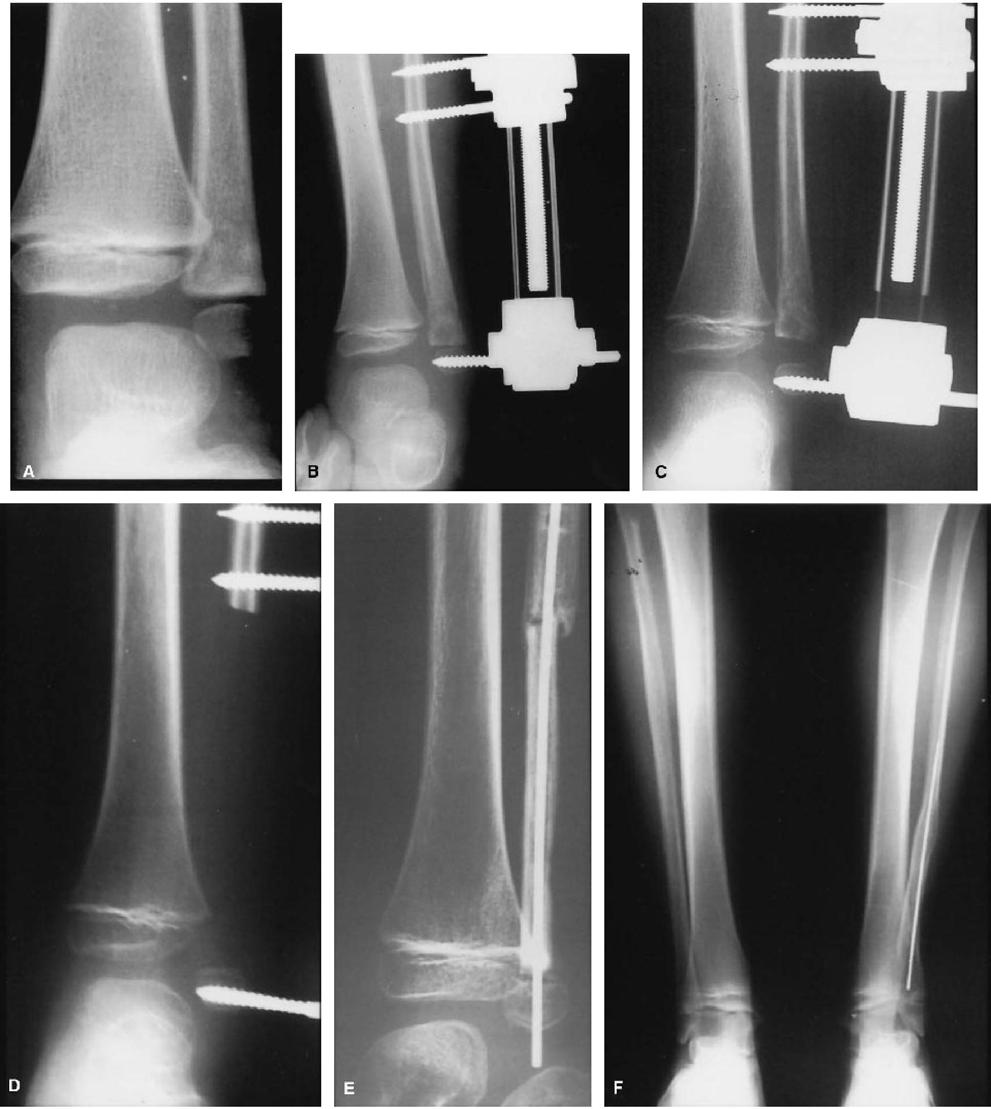 Figure 2. (A) A 4-year-old boy diagnosed with Ewing sarcoma in the distal fibula in 1985. (B D) Epiphysiolysis before excision of the tumor was performed.