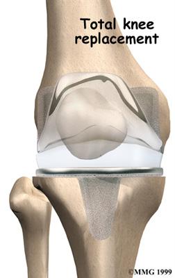 In this procedure, the upper (proximal) part of the shinbone (tibia) is cut, and the angle of the joint is changed.