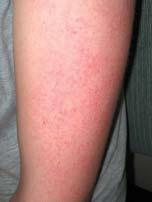 Case 2 Why s my arm so rough? A 12-year-old female presents with concerns regarding the unsightliness and roughness of her extensor arms. What can it be? a. Folliculitis b. Keratosis pilaris c.