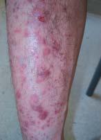 Case 3 Pruritic Purple Papules! A 45-year-old male presents with pruritic, purple papules on his shins, ankles and wrists. What can it be? a. Guttate psoriasis b. Lichen planus c.