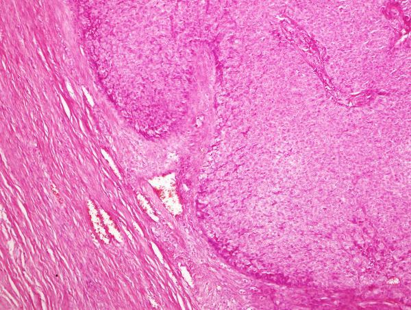 Mikropreparaat Gy 12. Granuloosrakk-kasvaja (tumor granulosacellularis).