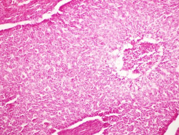 Mikropreparaat Gy 12. Granuloosrakk-kasvaja (tumor granulosacellularis).