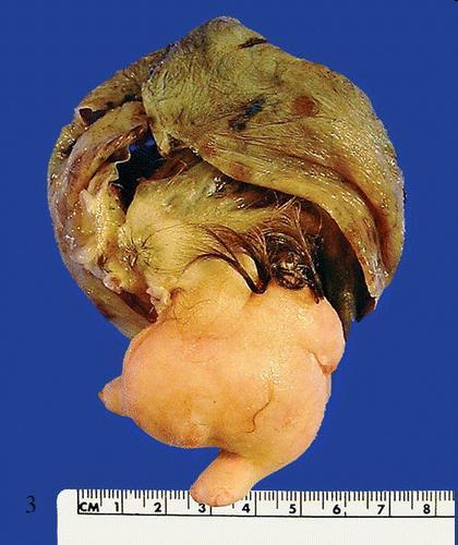 Fetiform teratoma (homunculus) is a term that has been given to a rare form of teratoma that resembles a malformed fetus.