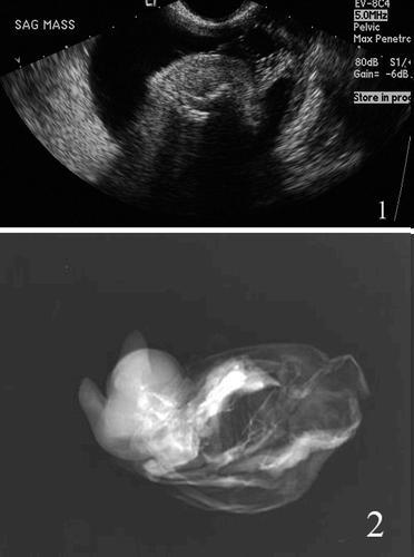 Ultrasound of the pelvis demonstrating a complex cystic mass within the left adnexa that measured 9.9 9.8 9.