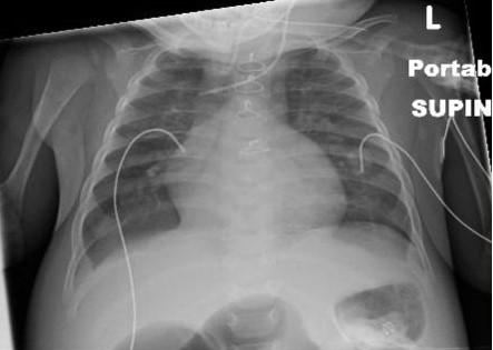 Pneumothorax Central