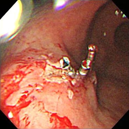 Bleeding was noted at the polypectomy site and controlled without difficulty using 3 hemoclips.