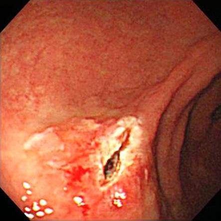 and a 0.8 cm sized polyp on the anterior wall of the antrum.