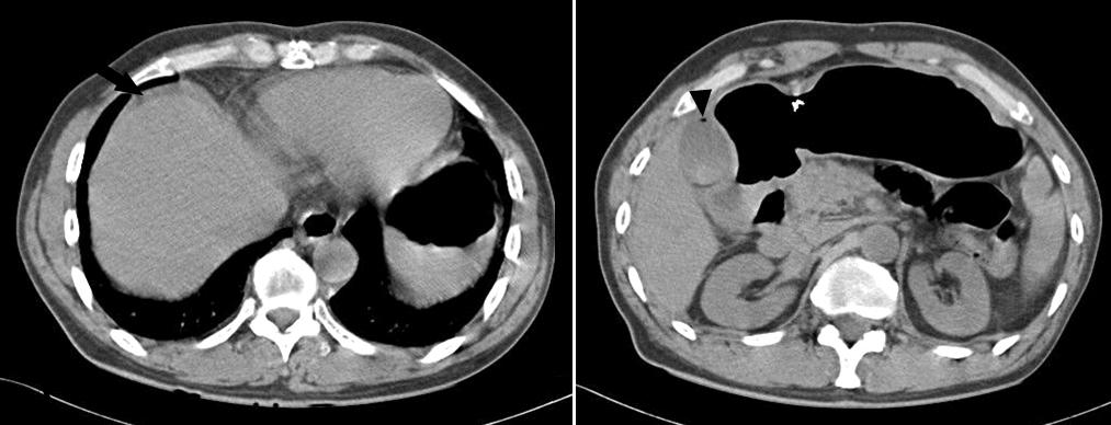 Nonenhanced computed tomography (CT) was performed and showed an air bubble abutting the wall of the gallbladder and a small quantity of fluid in the perihepatic space (Fig. 3A).