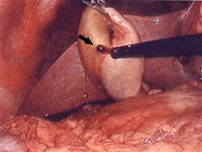 Se Kook Kee, et al:iatrogenic Gallbladder Perforation during Gastric EMR 231 Fig. 4. Intraoperative findings.