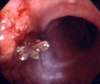 view. A laparoscopic cholecystectomy was performed easily and a closed-suction drain was placed in the subhepatic area. The resected gallbladder showed a normal-appearing mucosa with no stones.