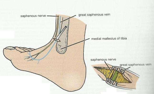 Just anterior and superior to the medial malleolus the great saphenous vein can readily be located and is frequently used for an emergency venous cutdown.