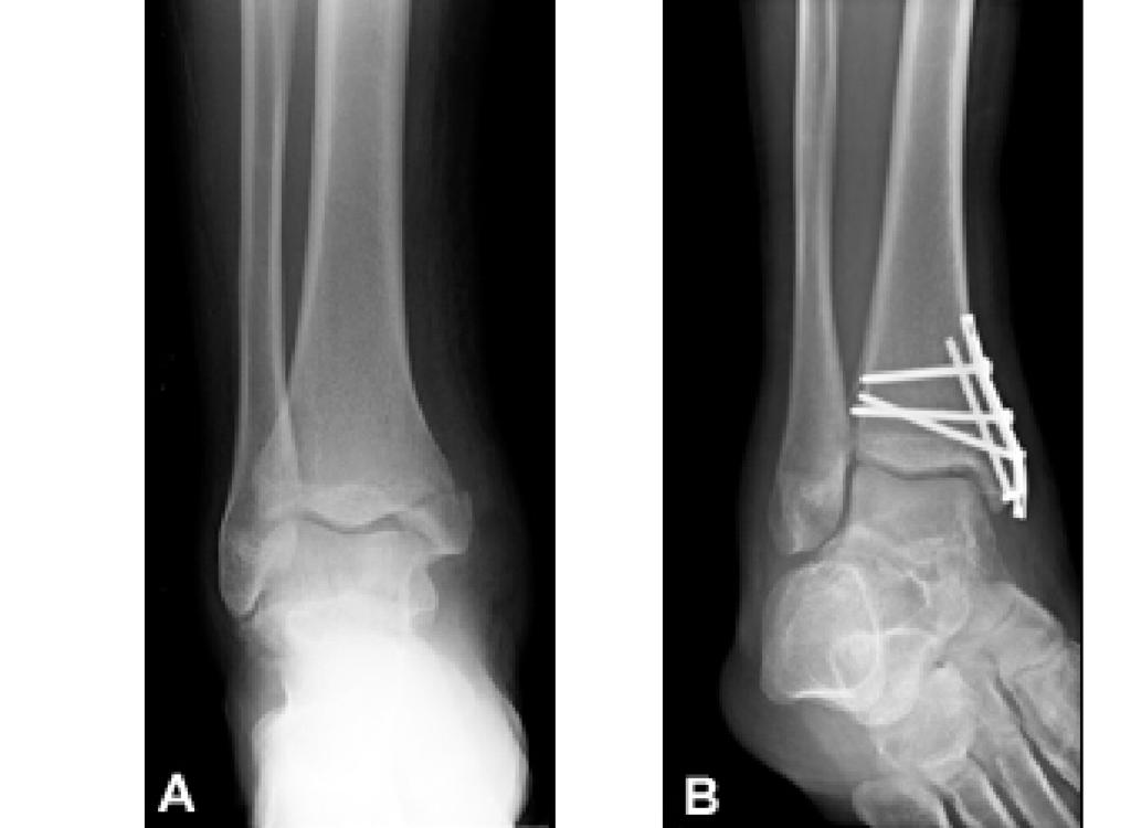 14 5 Jim is a footballer. He injures his ankle and undergoes surgical treatment. The surgery involves the insertion of metal implants to hold his bones in place. Fig. 5.1 shows X-ray images of Jim s ankle.