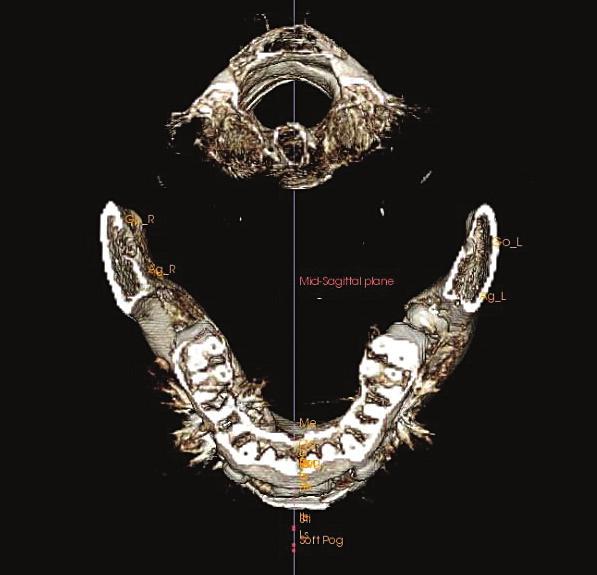 mandibular condyle erosion