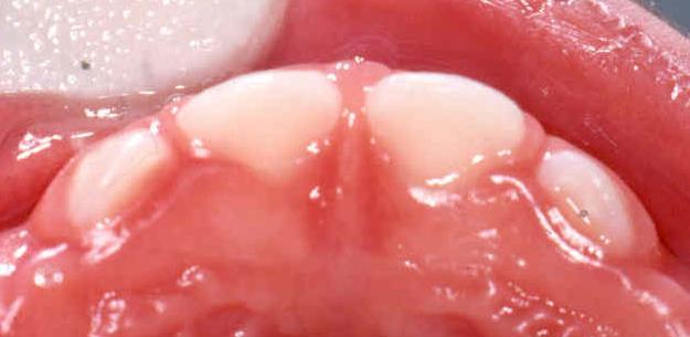 cavity, the child should be considered high risk for caries and be referred to a dentist for further evaluation