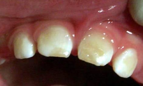 Etiology: Teeth 21 Nature of enamel defects 20 to 40% of children have enamel defects Defects may appear as changes in translucency, color, or