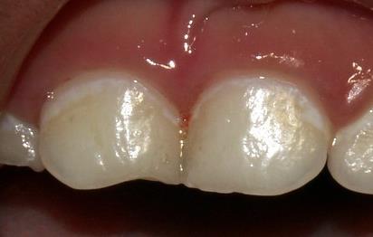 Enamel defects are associated with substantially increased risk of ECC Increased incidence of enamel defects is associated with: Lower