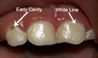 progress to cavities that are initially yellow Treatment Immediate dental referral Dietary and oral