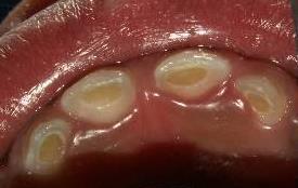 Brown Cavitations 23 Appearance & Symptoms Brown cavitations represent areas where loss of enamel has exposed underlying dentin