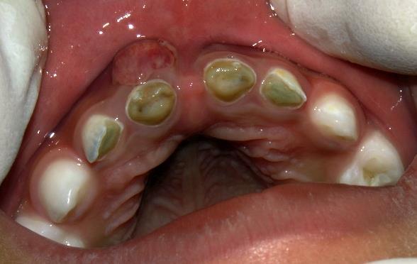 Advanced ECC 25 Appearance & Symptoms Multiple dark cavities appear in anterior and posterior teeth