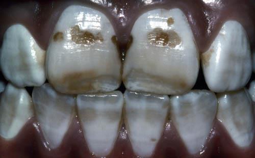 Fluorosis 36 Appearance and Significance White mottling of teeth due to chronic excessive fluoride exposure during tooth development Mainly a
