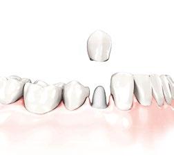 Solutions for restoring a damaged tooth Dental crown Chipped or cracked teeth should not be ignored. A dental crown is made of biocompatible material (such as ceramics) i.e. your body accepts it.