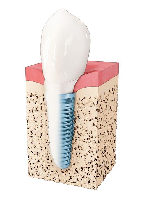 Solutions for restoring missing teeth Dental implants A dental implant replaces the tooth root and builds a stable foundation for crowns, bridges or replacement solutions for a toothless jaw.