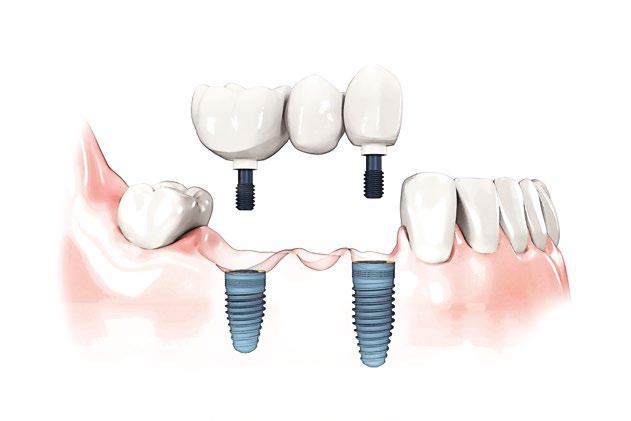 Placing a bridge on dental implants A bridge is a set of natural-looking replacement teeth. It prevents remaining teeth from shifting and influencing your bite.