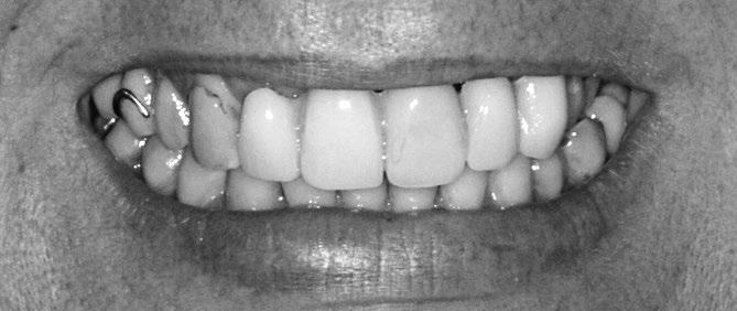 , 42: My teeth were an embarrassment for most of