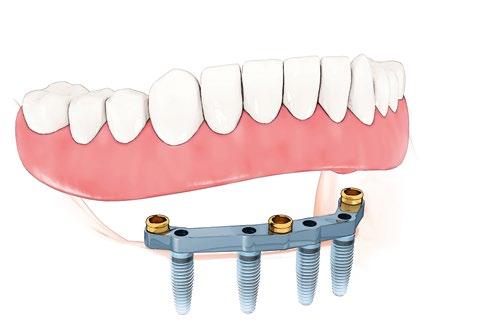 Fixed-removable bridge on two implants Fixed-removable solutions for toothless jaws use implants as fixed anchors. But you can easily remove the prosthesis yourself for cleaning.