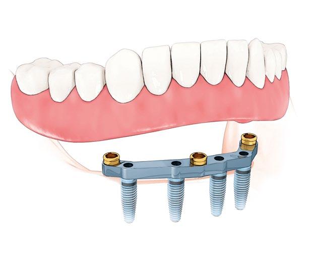 Fixed-removable bridge on two implants