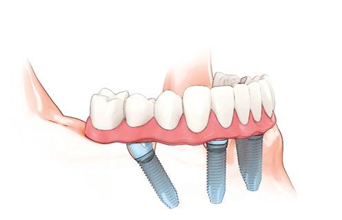 Fixed bridge on multiple implants Fixed solutions for toothless jaws use implants as anchors and securely fix the prosthesis to them. You cannot remove it yourself.