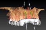 A Cone Beam CT scanner (CBCT) creates accurate 3D images of your jaw, which can then be viewed for diagnosis in special 3D planning software.