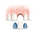 Conventional implant placement Treatment including tooth extraction 1 2 3 4 5 6 On the day of extraction, the damaged tooth is removed and the wound is sewn