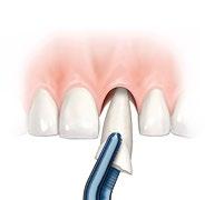 Conventional implant placement Treatment