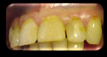 Posteriorly, amalgam was the material of choice owing to the large size of the restorations, low aesthetic requirement, more